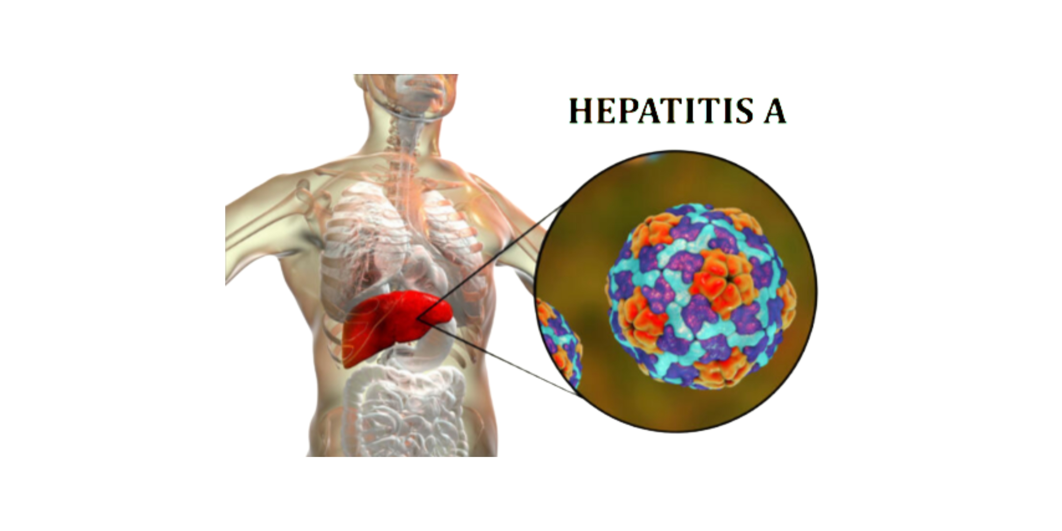 Hepatitis A Virus: A Foodborne Illness